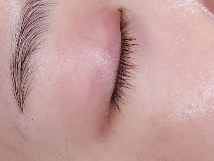 아토피 치료 초기