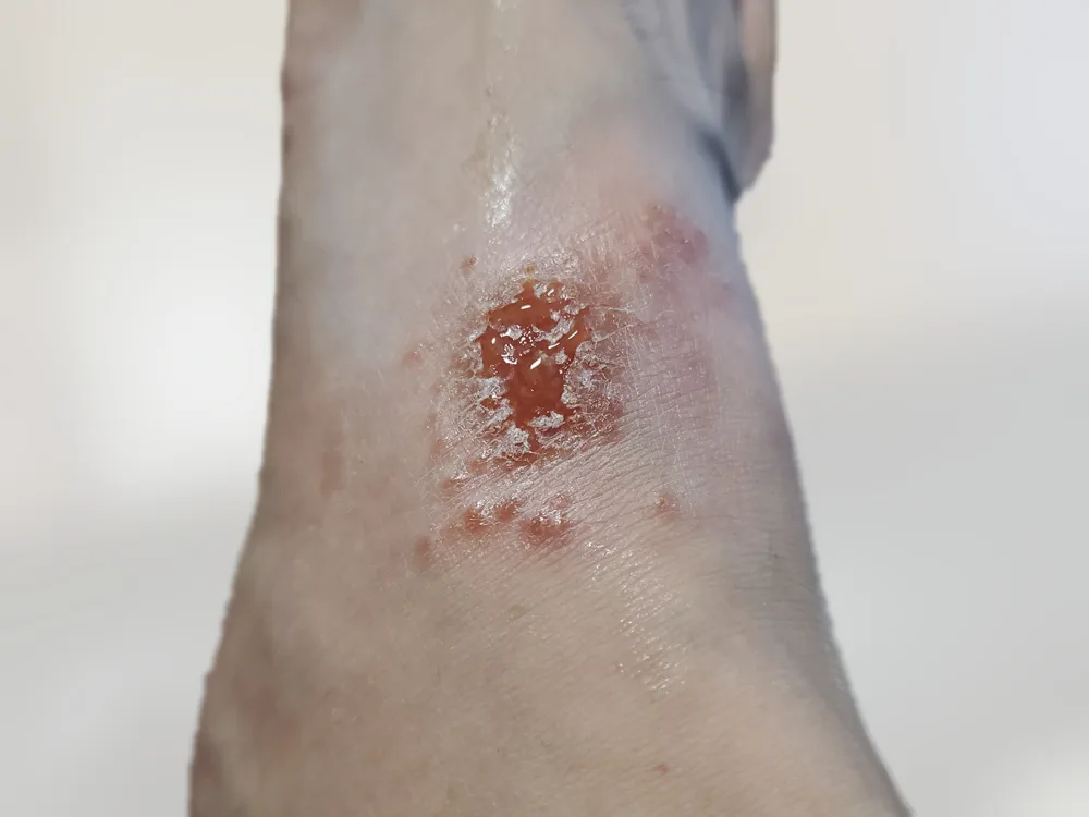 발등 화폐상습진 — 긁은 자리에서 진물이 배어 나온 병변