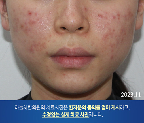 얼굴여드름