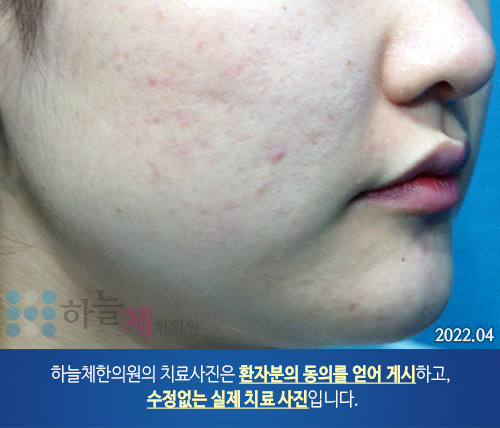 여드름흉터/자국